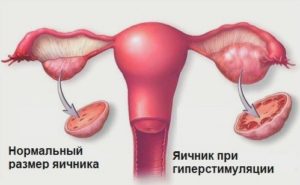 Как простимулировать яичники чтобы забеременеть