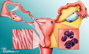 Эндометриоз лечение в домашних условиях