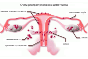 При эндометриозе какие выделения