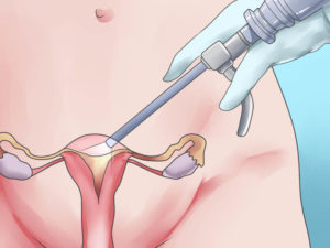 Операция по удалению матки и яичников послеоперационный период