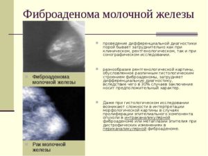Фиброаденоматоз молочной железы лечение