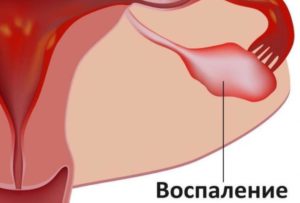 Признаки воспаления придатков и яичников