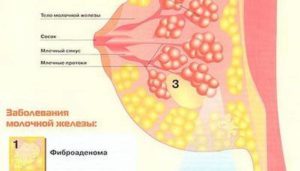 Фам молочной железы что это такое как лечить