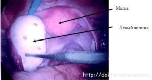 Лапароскопия поликистоз яичников