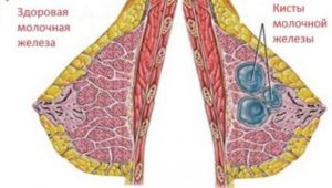 Кистозные образования молочной железы