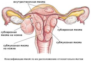 Актовегин при миоме матки