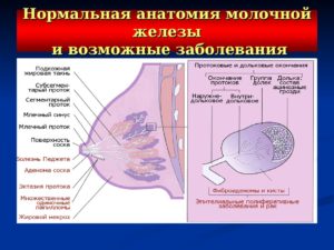 Дуктэктазия молочной железы лечение