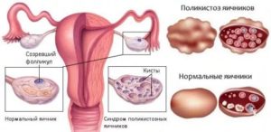 Синдром поликистозных яичников при планировании беременности