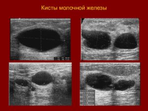 Атипичная киста молочной железы