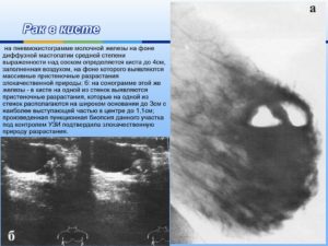 Как отличить кисту молочной железы от рака