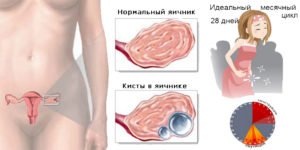 Киста яичника как влияет на беременность