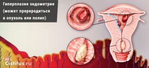 Гиперплазия эндометрия и эндометриоз это одно и то же
