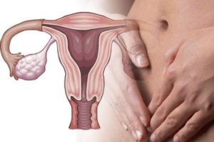 Патология яичников у женщин