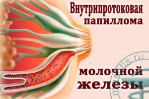 Внутрипротоковая папиллома молочной железы