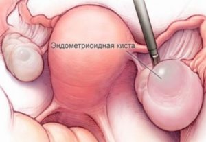 Киста на яичнике лечение или операция