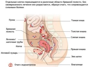 Боли при эндометриозе отдающие в кишечнике