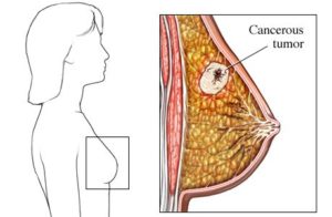 Рак молочной железы как начинается