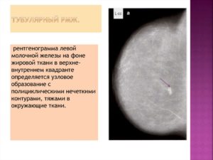 Узловое образование левой молочной железы