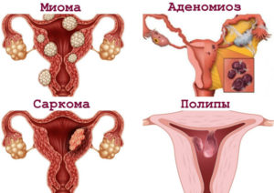 Аденомиоз и миома матки это одно и тоже