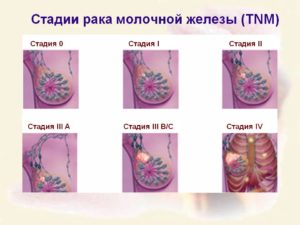 Онкология молочной железы 1 стадия