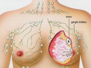 Лимфоузел в молочной железе что это такое