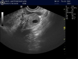 Желтое тело в левом яичнике при беременности на ранних сроках