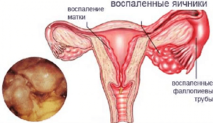 При воспалении яичников могут быть месячные