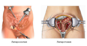 Операция на яичники у женщин