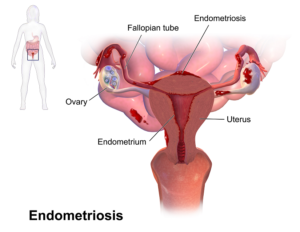 При эндометриозе болит поясница
