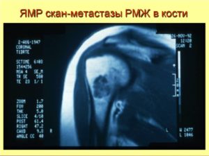 При раке молочной железы метастазы в костях