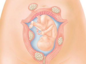 Как влияет миома матки на беременность