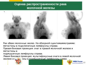 Инвалидность при раке молочной железы