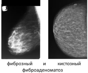 Диффузная фиброаденома молочной железы