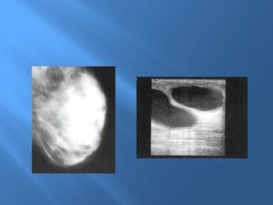 Солитарная киста молочной железы
