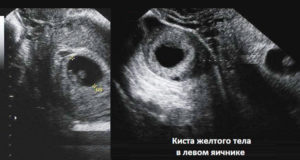 Киста желтого тела левого яичника при беременности