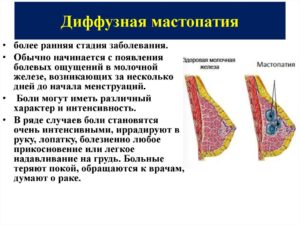 Дфкм средней степени выраженности в обеих молочных железах