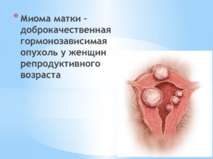 Миома глаза