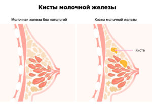 Киста в молочной железе у женщины