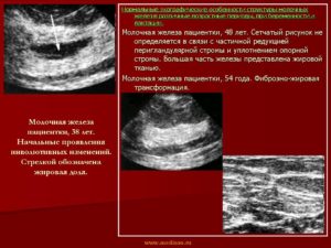 Можно ли делать при беременности узи молочных желез