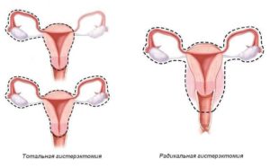 Удаление матки без яичников последствия