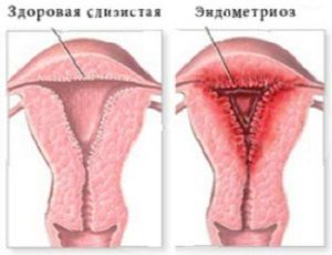 Эндометриоз причины психологические