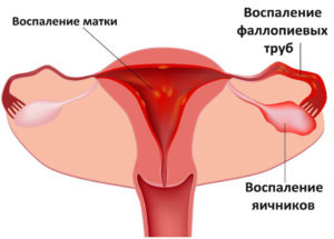 Как определить воспаление яичников у женщин