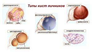 Киста яичника виды кист