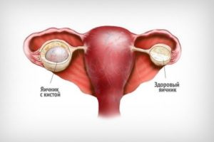 Может ли быть задержка месячных из за кисты яичника