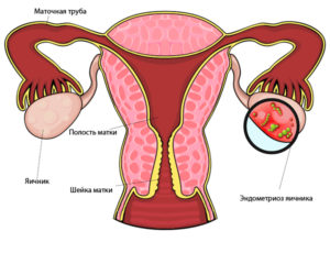 Эндометриоз левого яичника