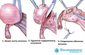 Операция полостная по удалению кисты яичника