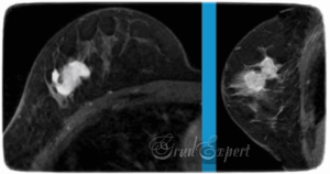 Мрт молочных желез с контрастом что показывает