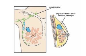 Лимфоузел в молочной железе что это такое