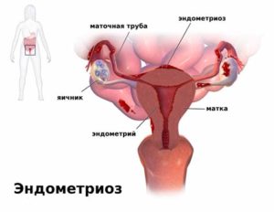 Эндометриоз матки при климаксе симптомы и лечение