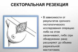 Удаление фиброаденомы молочной железы секторальная резекция